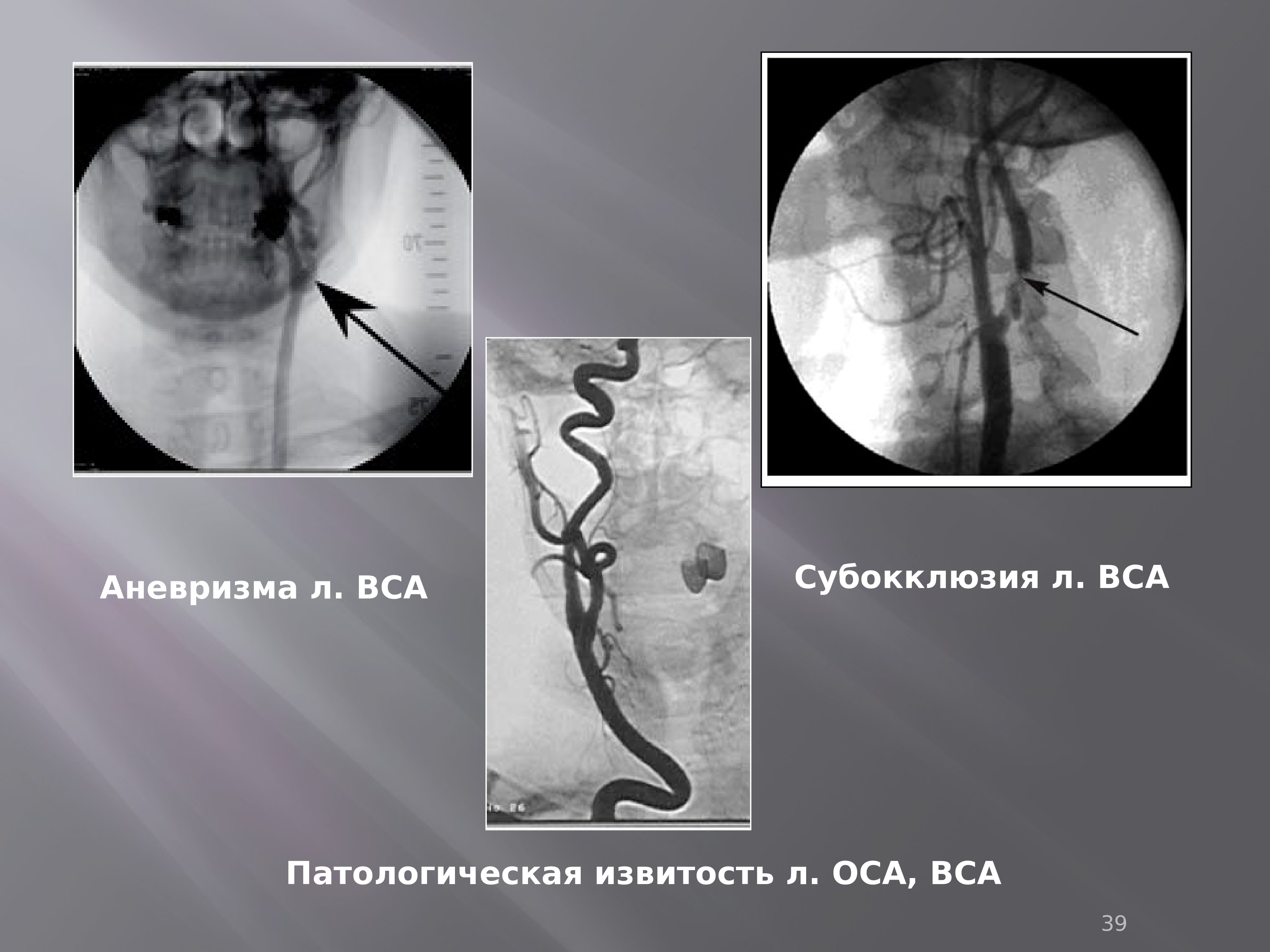 S извитость сонной артерии