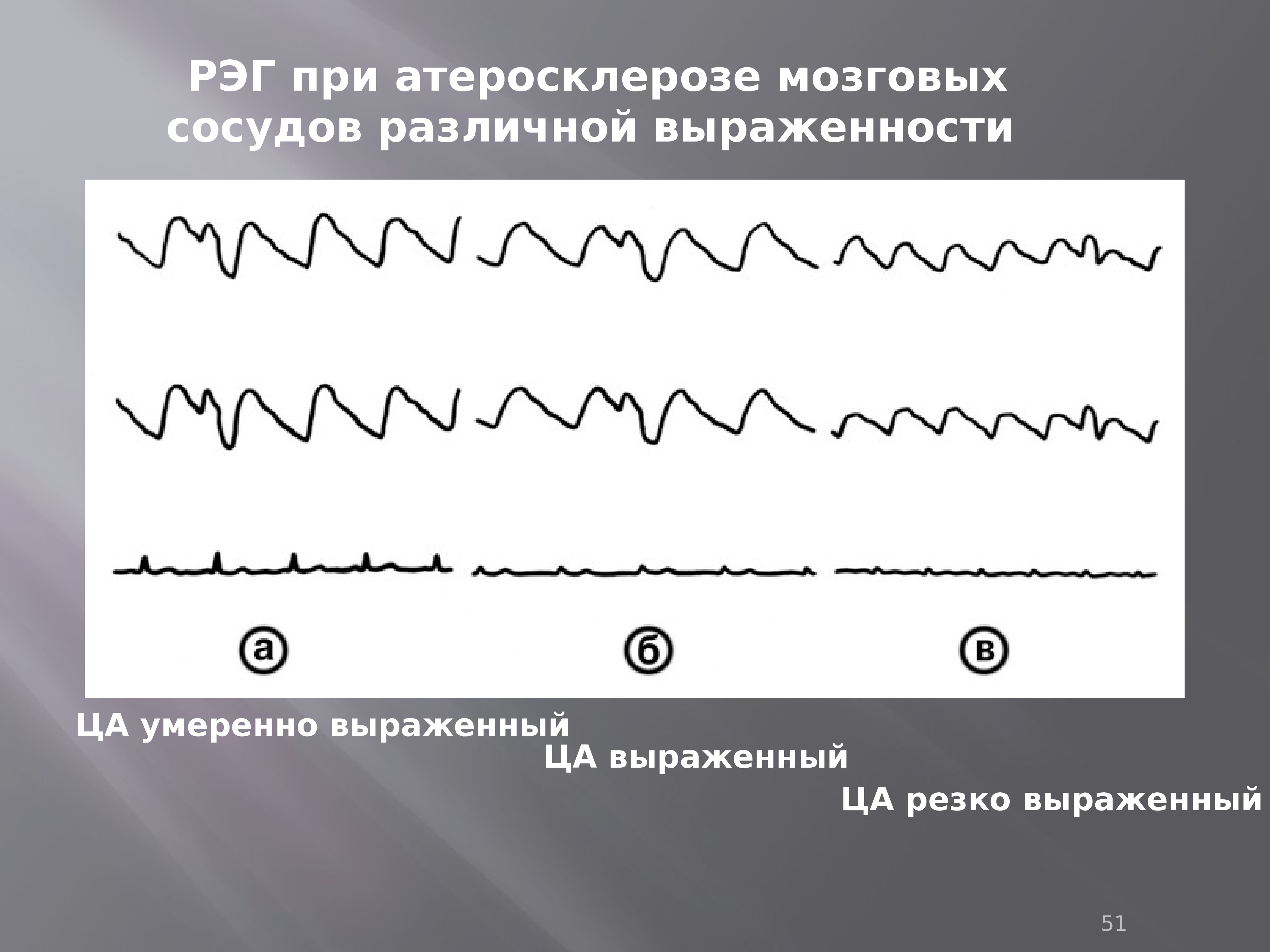 Резко выраженный. Показатели РЭГ головы расшифровка. Гипотонический Тип РЭГ. Реоэнцефалография расшифровка. Реоэнцефалография презентация.