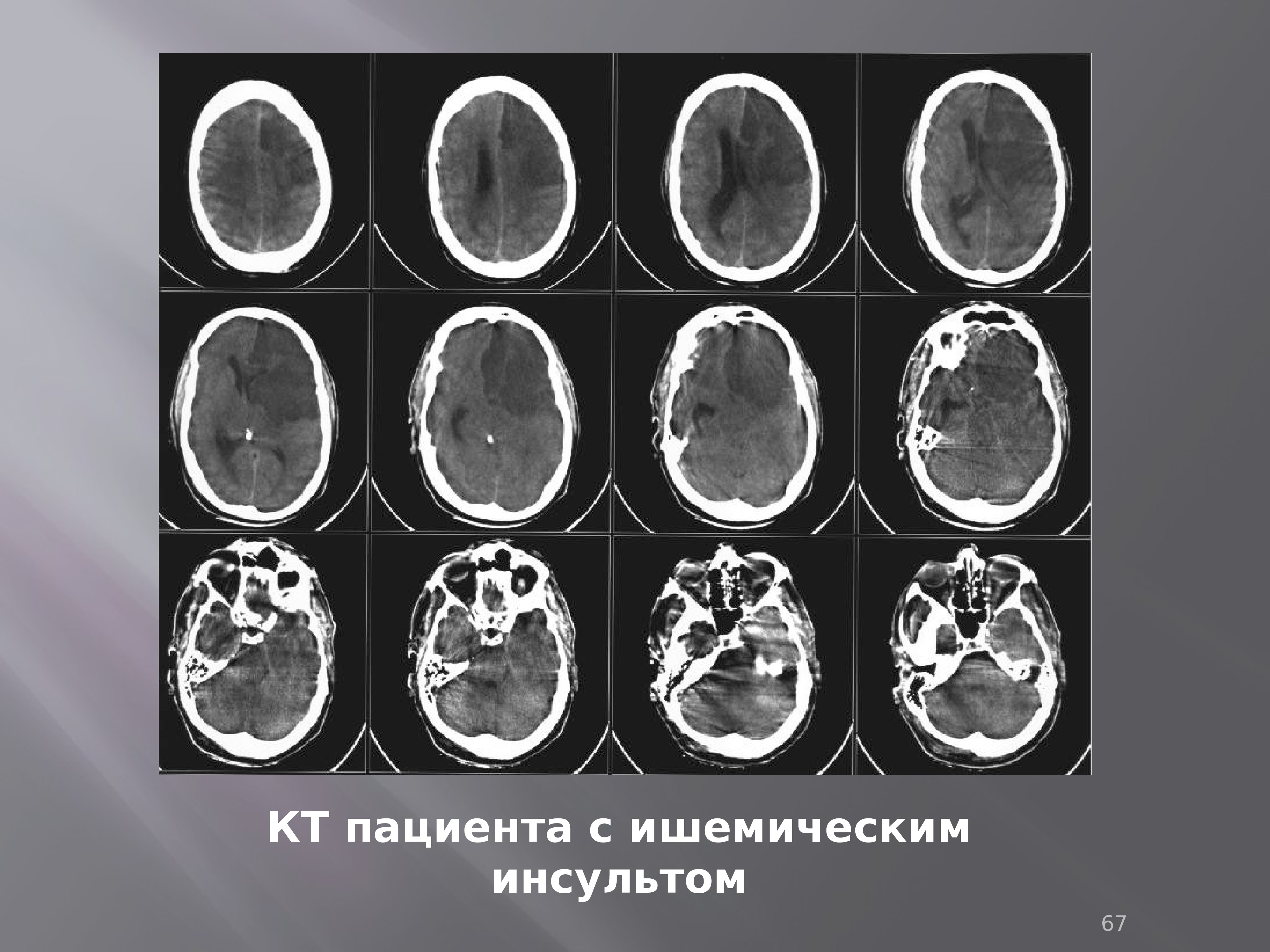 Диагностика инсульта. Ишемический инсульт лобной доли кт. Периоды ишемического инсульта кт. Кт больного с ишемическим инсультом. Полушарный ишемический инсульт.