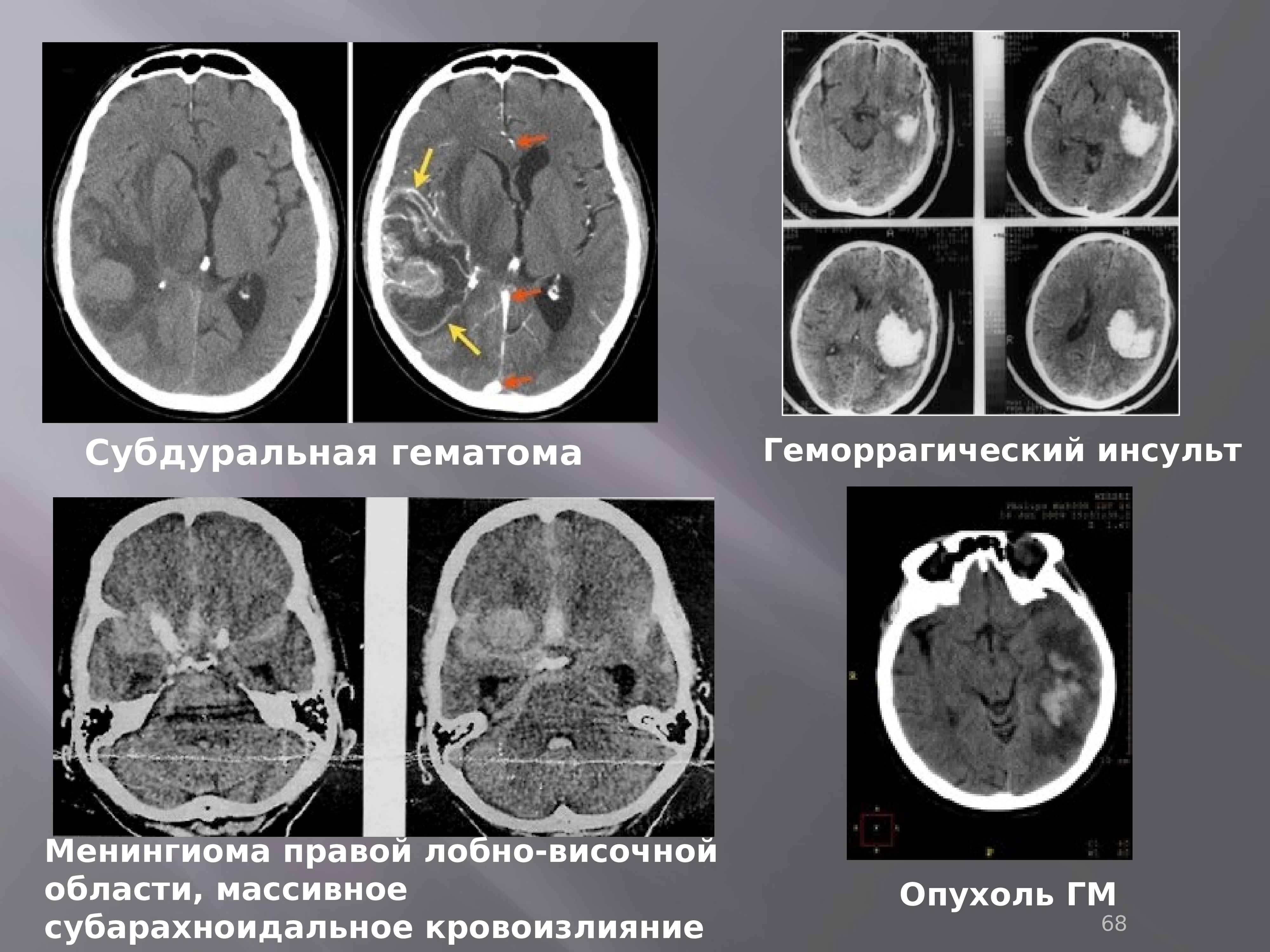 Геморрагический инсульт неврология презентация