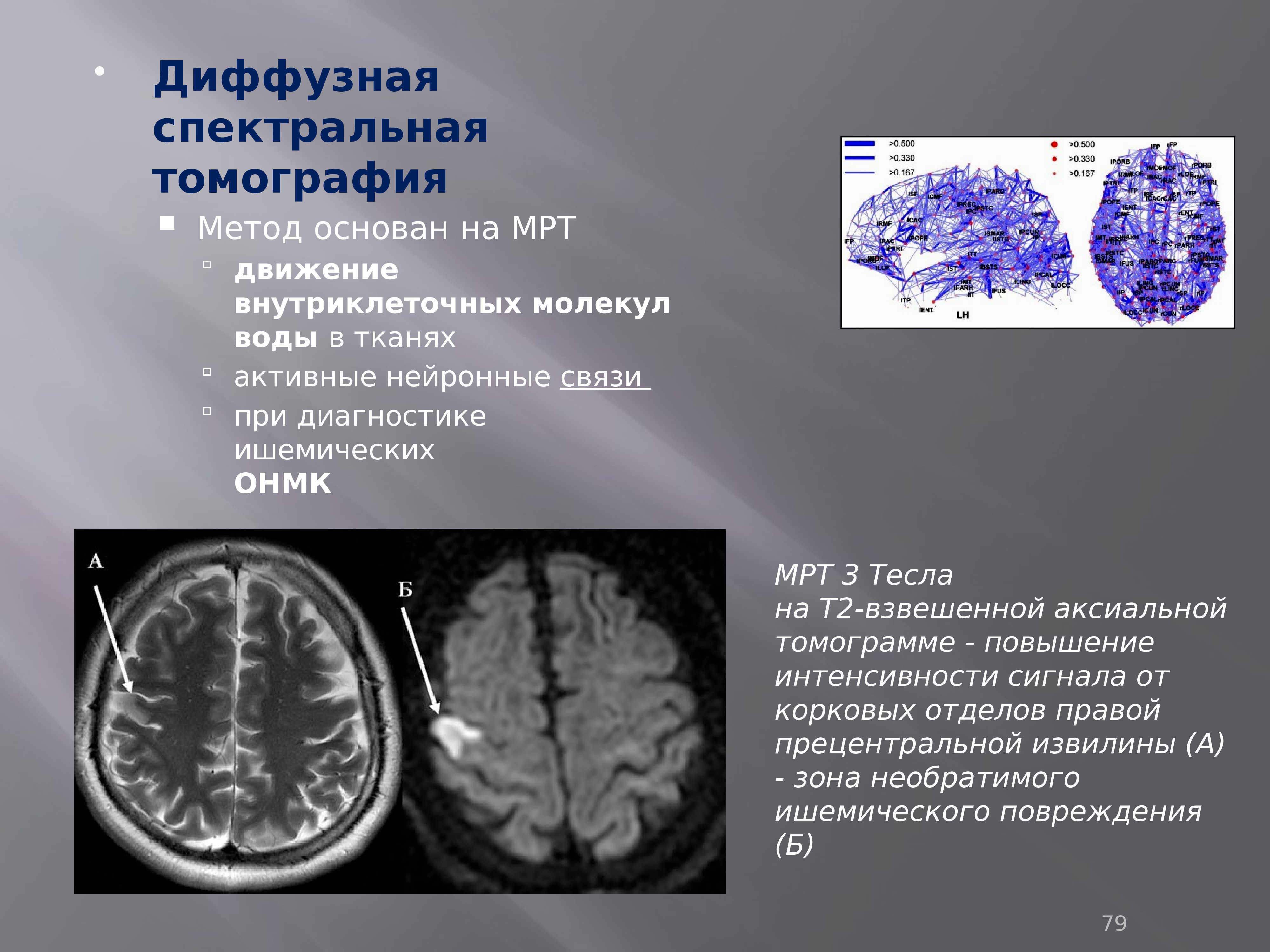 Интенсивность сигнала мрт. Спектральные томографы,. Эпендимома бокового желудочка на мрт.