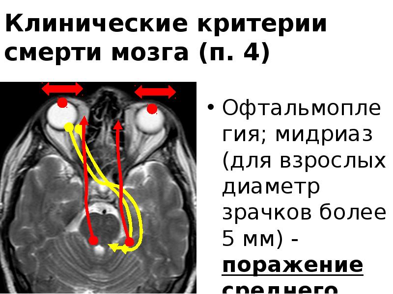 Смерть мозга презентация