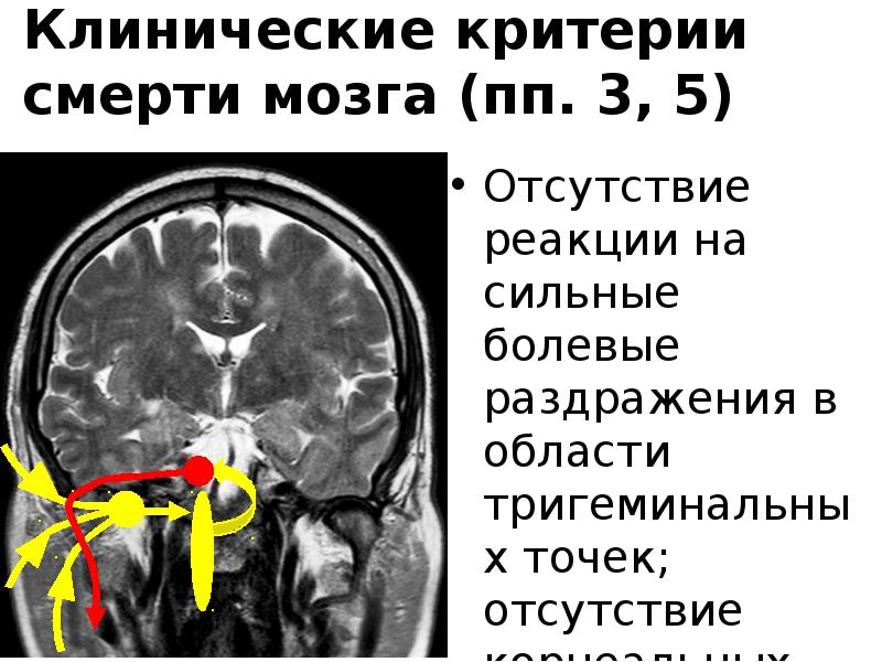 Смерть мозга презентация