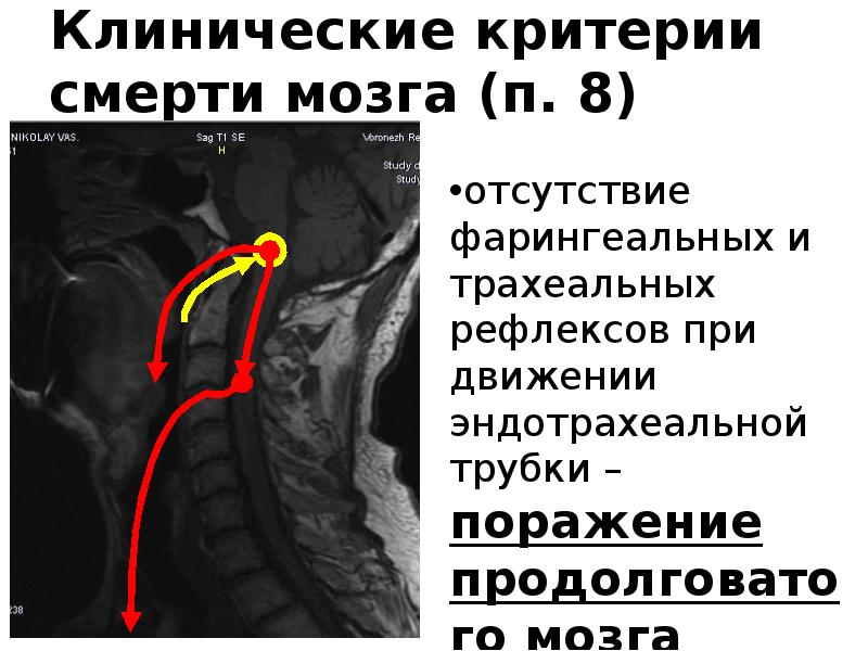 Гибель мозгового. Фарингеальные и трахеальные рефлексы.