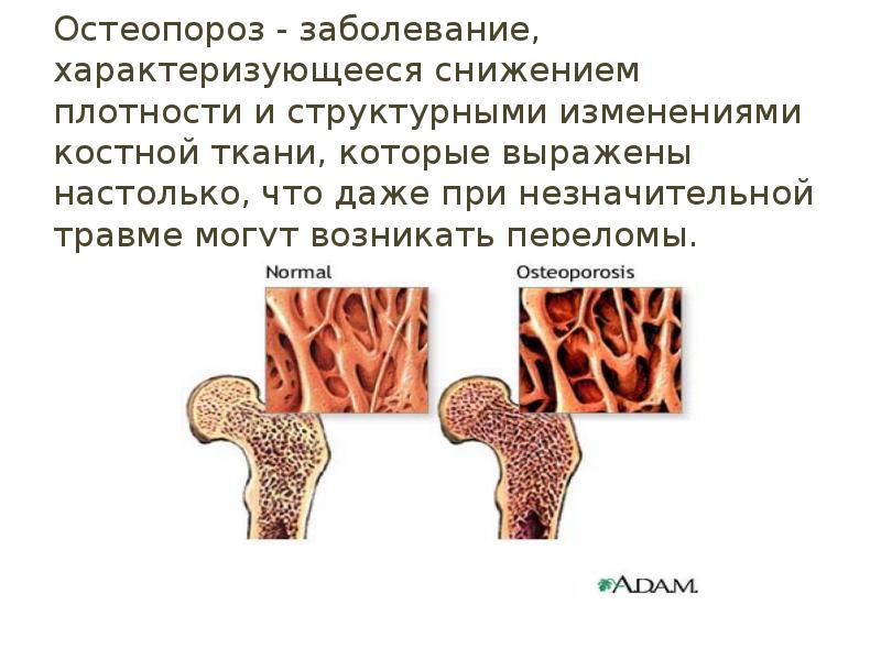Остеопороз - заболевание, характеризующееся снижением плотности и структурными изменениями костной ткани, Остеопороз - заболевание, характеризующееся снижением плотности и структурными изменениями костной ткани,