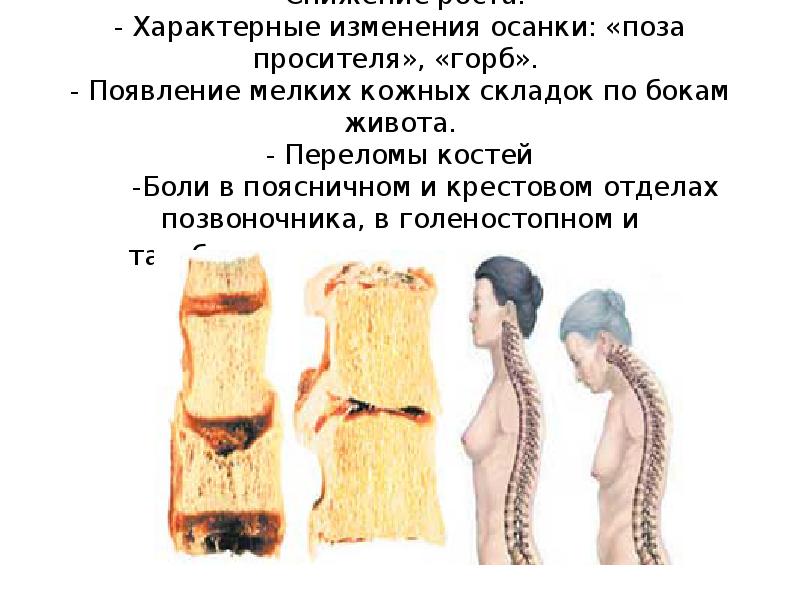- Снижение роста. - Характерные изменения осанки: «поза просителя», «горб». - - Снижение роста. - Характерные изменения осанки: «поза просителя», «горб». -