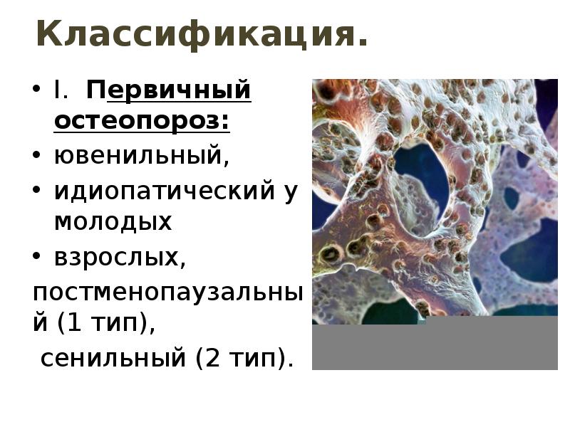 Классификация.
I. Первичный остеопороз:
ювенильный,
идиопатический у молодых
Классификация.
I. Первичный остеопороз:
ювенильный,
идиопатический у молодых
