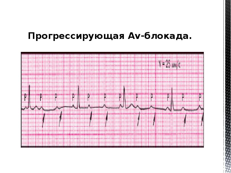 Ав блокады картинки