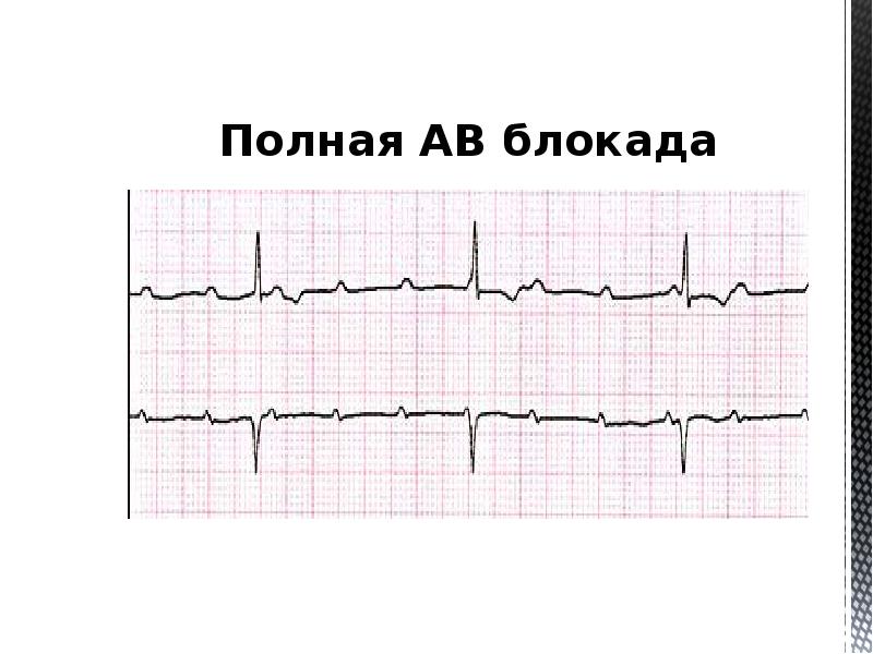 Ав блокада презентация