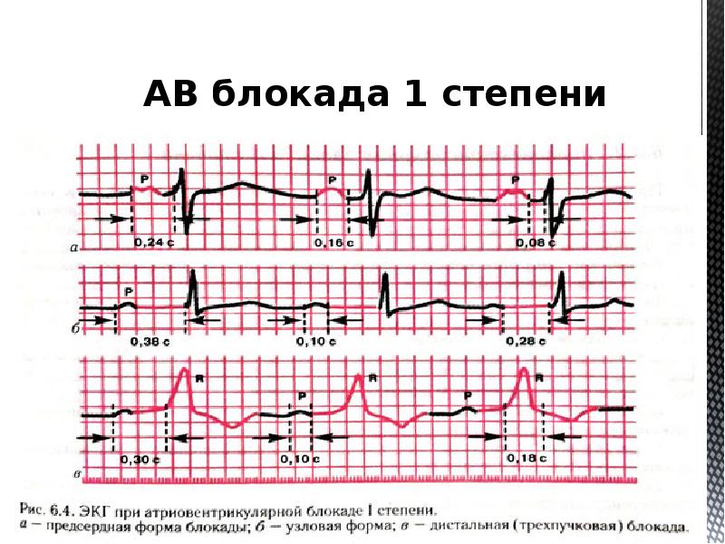 Полная ав блокада карта вызова