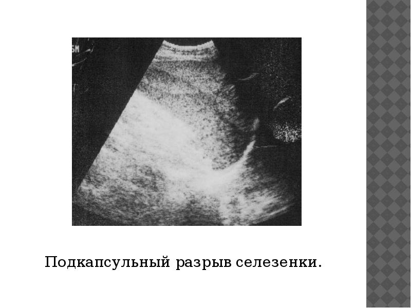 Разрыв селезенки у ребенка. Чрезкапсульный разрыв селезенки. УЗИ признаки разрыва селезенки. Гематома селезенки на УЗИ. Разрыв капсулы селезенки.