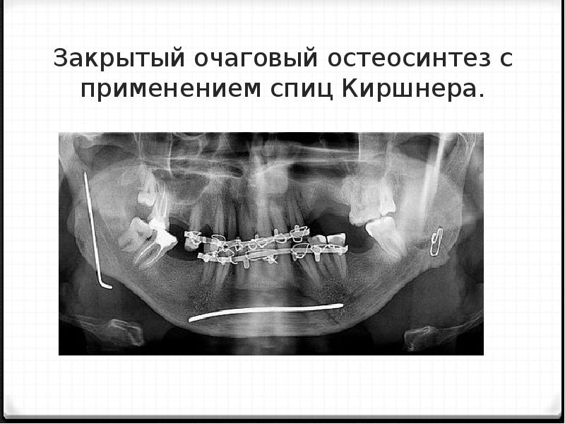 Травмы челюстно лицевой области стоматология презентация