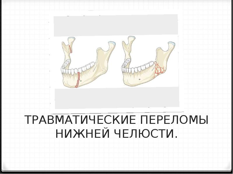 Признаки перелома нижней челюсти