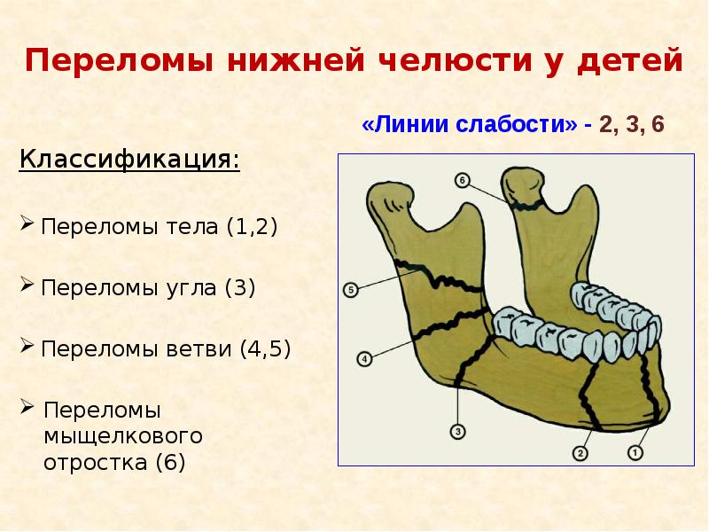 Перелом нижней челюсти фото Травматические повреждения челюстей у детей