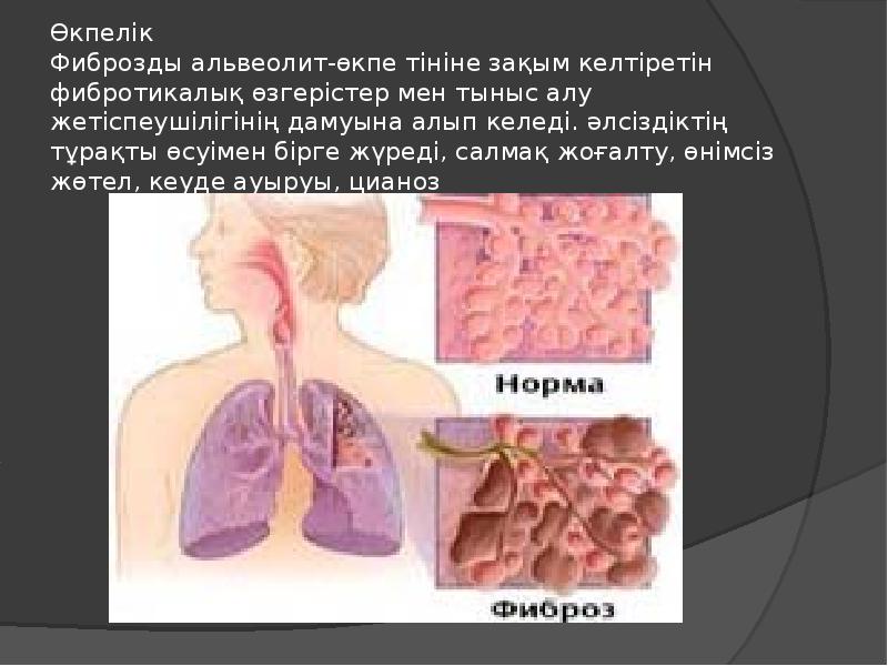 Созылмалы пневмония презентация