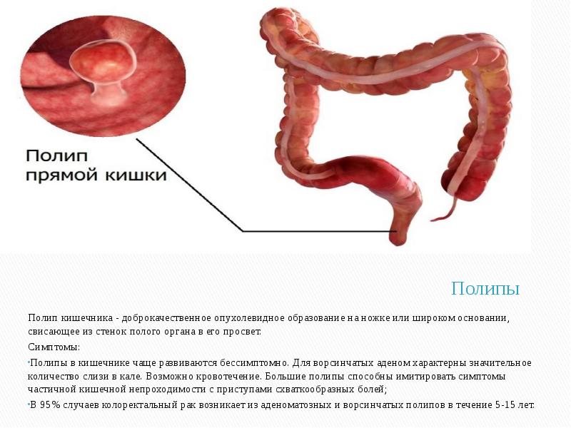 Выпадение полипа прямой кишки фото