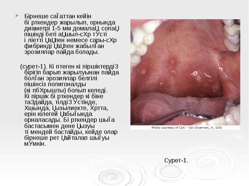Бірнеше сағаттан кейін бөрткендер жарылып, орнында диаметрі 1-5 мм домалақ, сопақ Бірнеше сағаттан кейін бөрткендер жарылып, орнында диаметрі 1-5 мм домалақ, сопақ