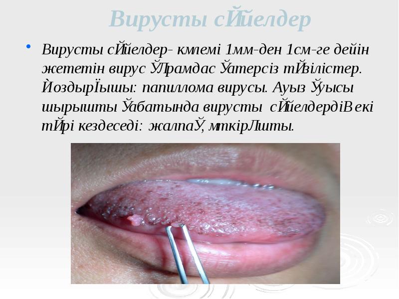 Вирусты сүйелдер
Вирусты сүйелдер- көлемі 1мм-ден 1см-ге дейін жететін вирус құрамдас Вирусты сүйелдер
Вирусты сүйелдер- көлемі 1мм-ден 1см-ге дейін жететін вирус құрамдас