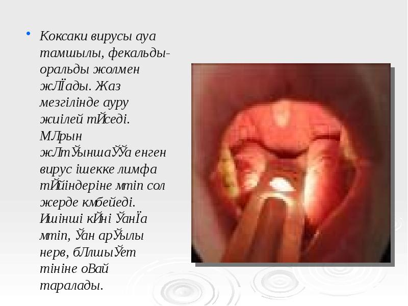 Коксаки вирусы ауа тамшылы, фекальды-оральды жолмен жұғады. Жаз мезгілінде ауру жиілей Коксаки вирусы ауа тамшылы, фекальды-оральды жолмен жұғады. Жаз мезгілінде ауру жиілей