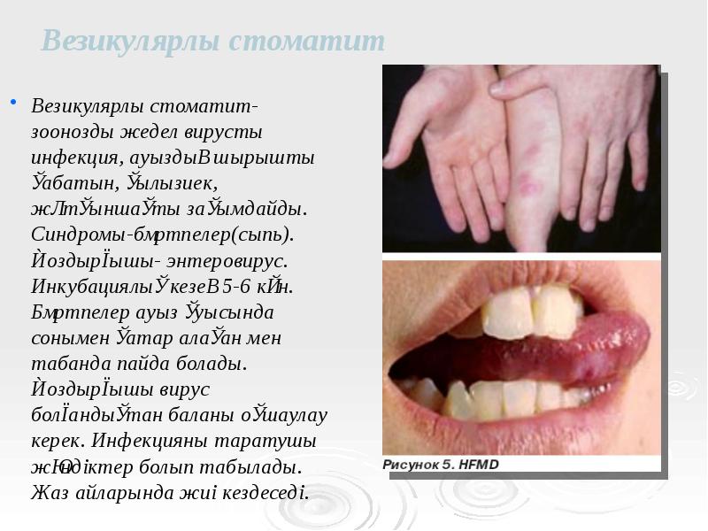 Везикулярлы стоматит
Везикулярлы стоматит- зоонозды жедел вирусты инфекция, ауыздың шырышты қабатын, Везикулярлы стоматит
Везикулярлы стоматит- зоонозды жедел вирусты инфекция, ауыздың шырышты қабатын,