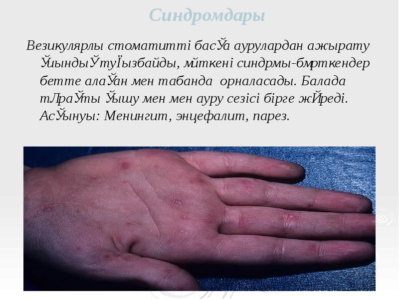 Синдромдары
Везикулярлы стоматитті басқа аурулардан ажырату қиындық туғызбайды, өйткені синдрмы-бөрткендер бетте Синдромдары
Везикулярлы стоматитті басқа аурулардан ажырату қиындық туғызбайды, өйткені синдрмы-бөрткендер бетте