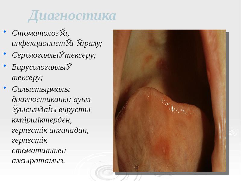 Диагностика
Стоматологқа, инфекционистқа қаралу;
Серологиялық тексеру;
Вирусологиялық тексеру;
Салыстырмалы диагностиканы: ауыз Диагностика
Стоматологқа, инфекционистқа қаралу;
Серологиялық тексеру;
Вирусологиялық тексеру;
Салыстырмалы диагностиканы: ауыз
