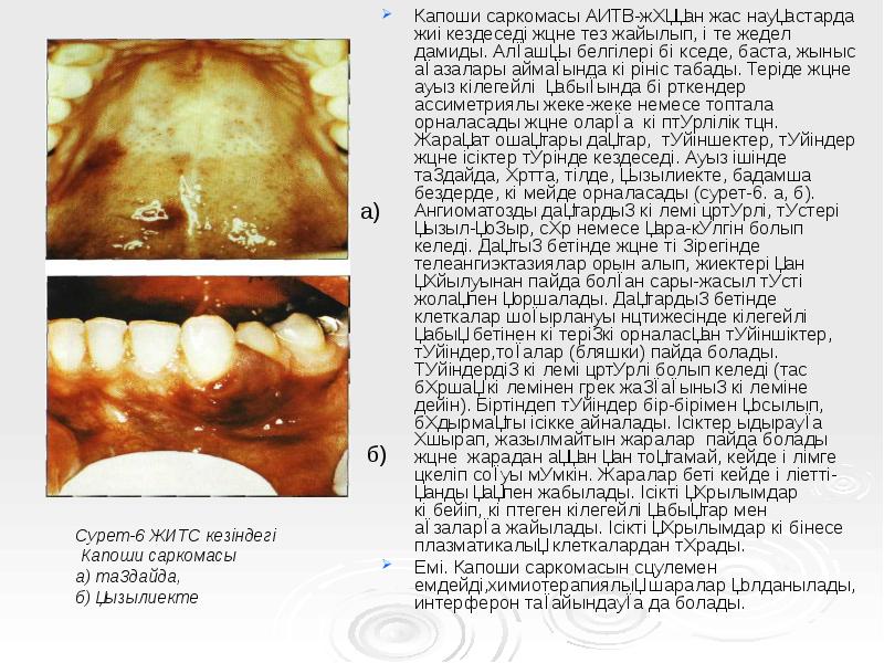 Капоши саркомасы АИТВ-жұққан жас науқастарда жиі кездеседі және тез жайылып, өте Капоши саркомасы АИТВ-жұққан жас науқастарда жиі кездеседі және тез жайылып, өте