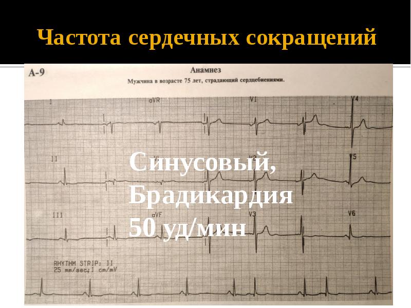 План анализа экг