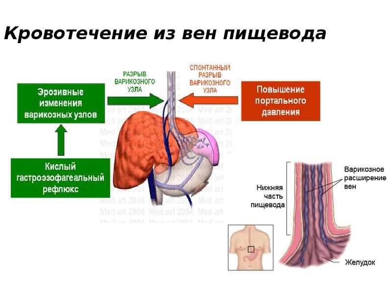 Желудочное кровотечение карта вызова скорой