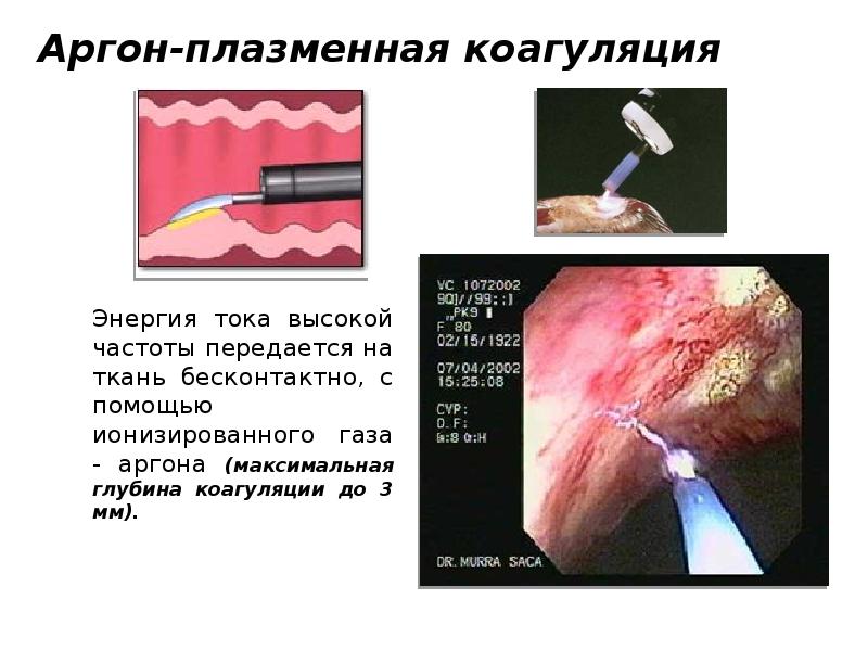 Возможная локализация кровотечения при дегтеобразном стуле