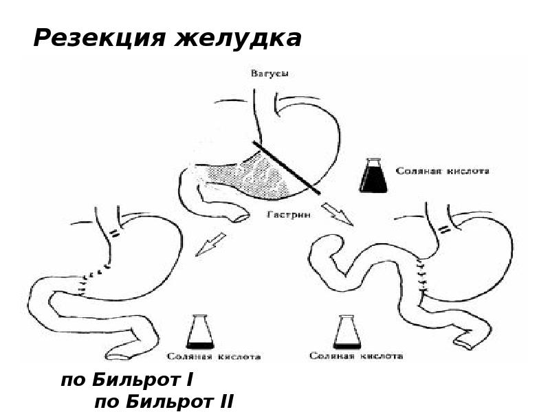 Бильрот 1 и 2 отличия схема