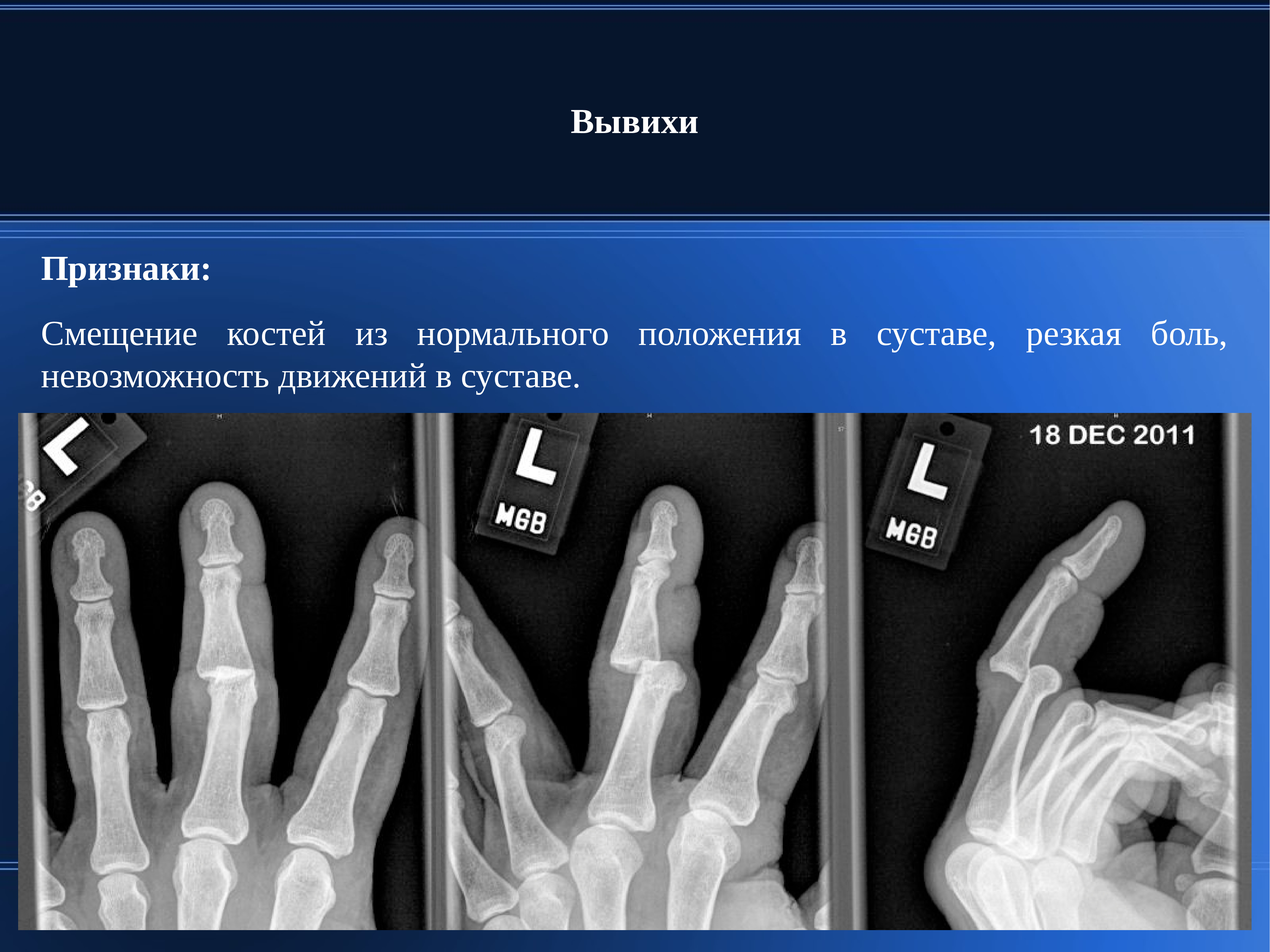 Вывих признаки. Смещение кости в суставе. Смещение кости признаки.