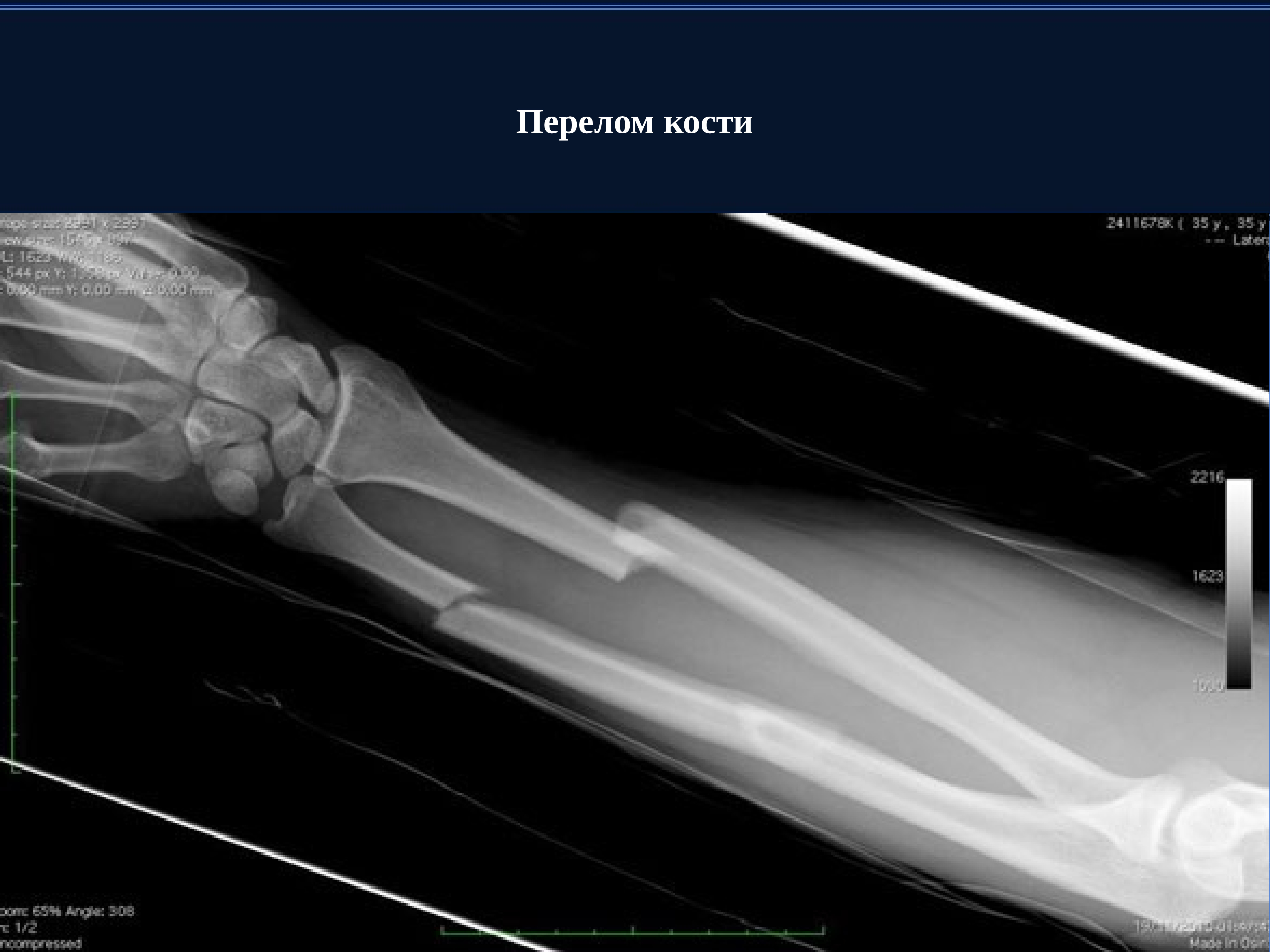 Как определить трещину в кости. Перелом лучевой кости рентген. Рентген предплечья перелом локтевой кости. Перелом костей предплечья рентген. Перелом 2 костей предплечья со смещением.