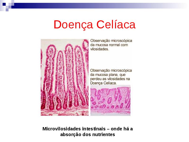 Doença Celíaca Doença Celíaca