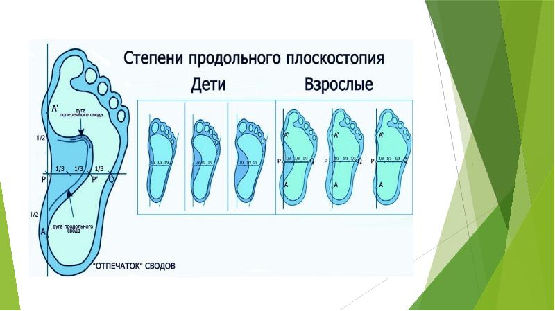 Поперечное плоскостопие презентация