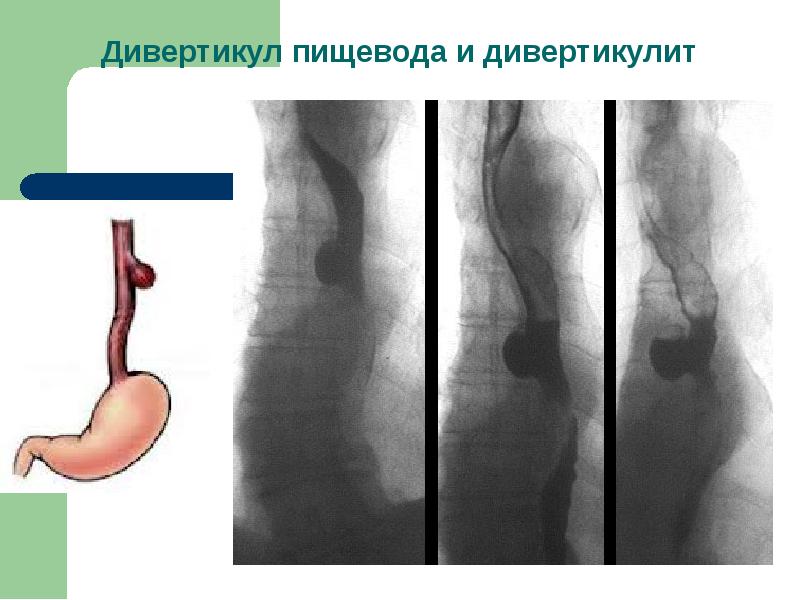 Травмы пищевода презентация