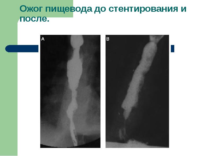 Травмы пищевода презентация