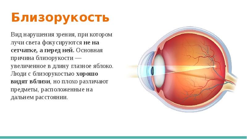 Причины заболевания зрения. Таблица заболевания глаз близорукость и дальнозоркость. Близорукость сообщение по биологии. Причины нарушения зрения близорукость дальнозоркость. Причины развития близорукости и дальнозоркости.