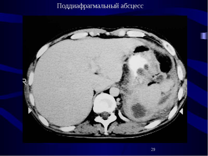 Абсцесс брюшной полости презентация