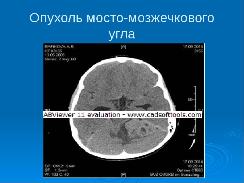 Мосто мозжечковый угол