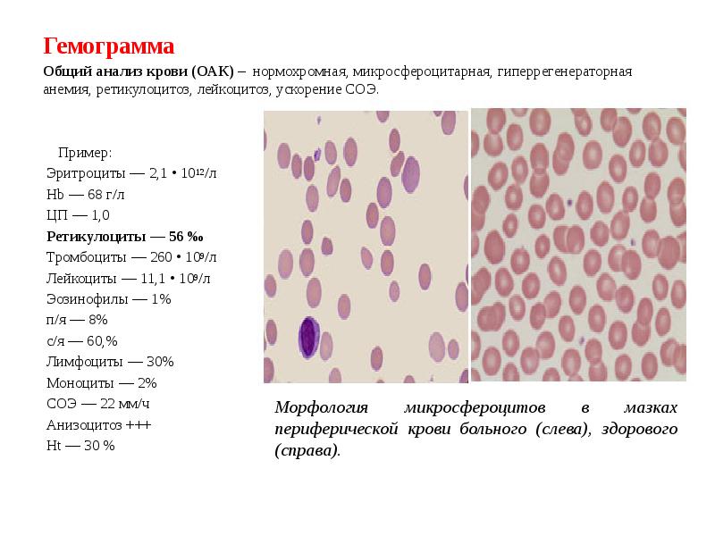 Гемограмма. Микросфероцитарная анемия анализ крови. Нормохромная анемия гемограмма. Нормохромная анемия картина крови. Анализ крови гемограмма.