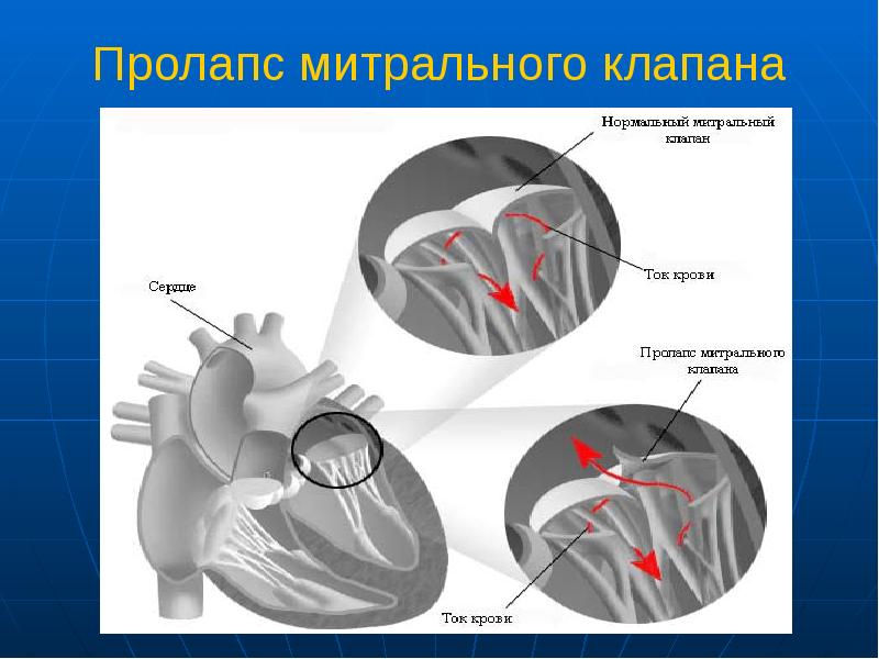 Малые аномалии развития сердца у детей презентация