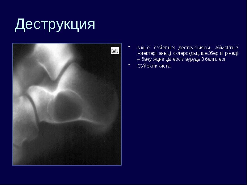 Рентгенологические признаки деструкции костной ткани. Очаг деструкции костной ткани рентген. Рентгенологические симптомы деструкции кости. Диструкция или деструкция что это. Диструкция или деструкция что это.