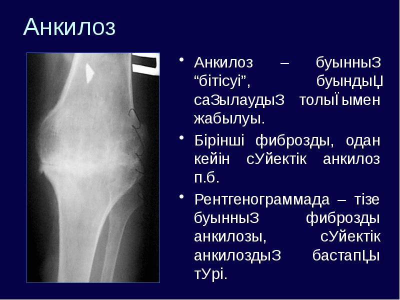 Анкилоз сустава у животных. Анкилоз коленного сустава рентген описание.