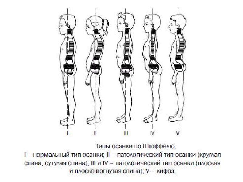 Рассмотрите рисунки 1 4 с изображением типов осанок человека как называют нарушение осанки 4