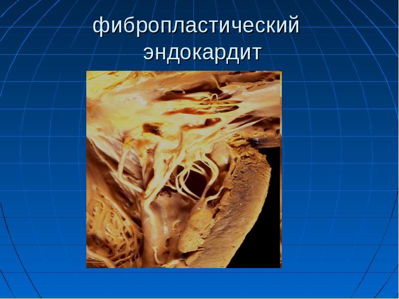 Эндокардиты у детей презентация