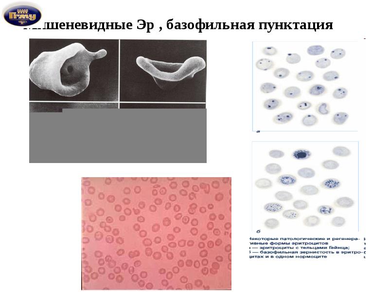 Базофильная пунктация эритроцитов фото
