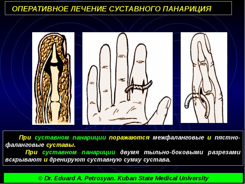 Панариций мазь. Операции при панариции. Методика вскрытия панариция.