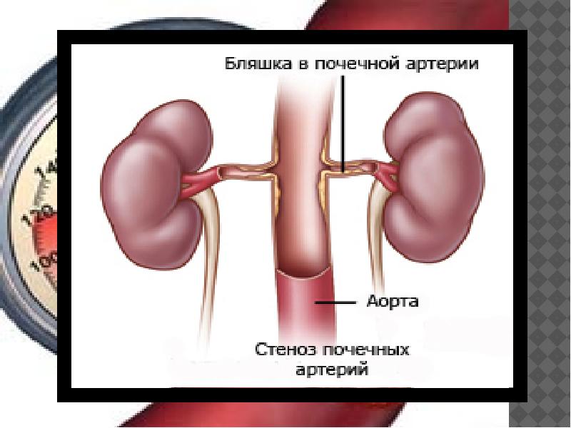 Почечная гипертония презентация