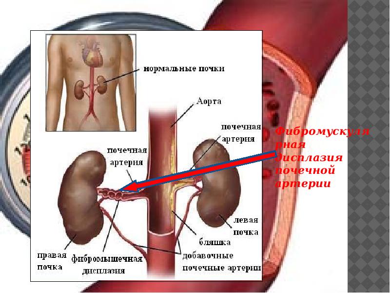 Почечная гипертония презентация